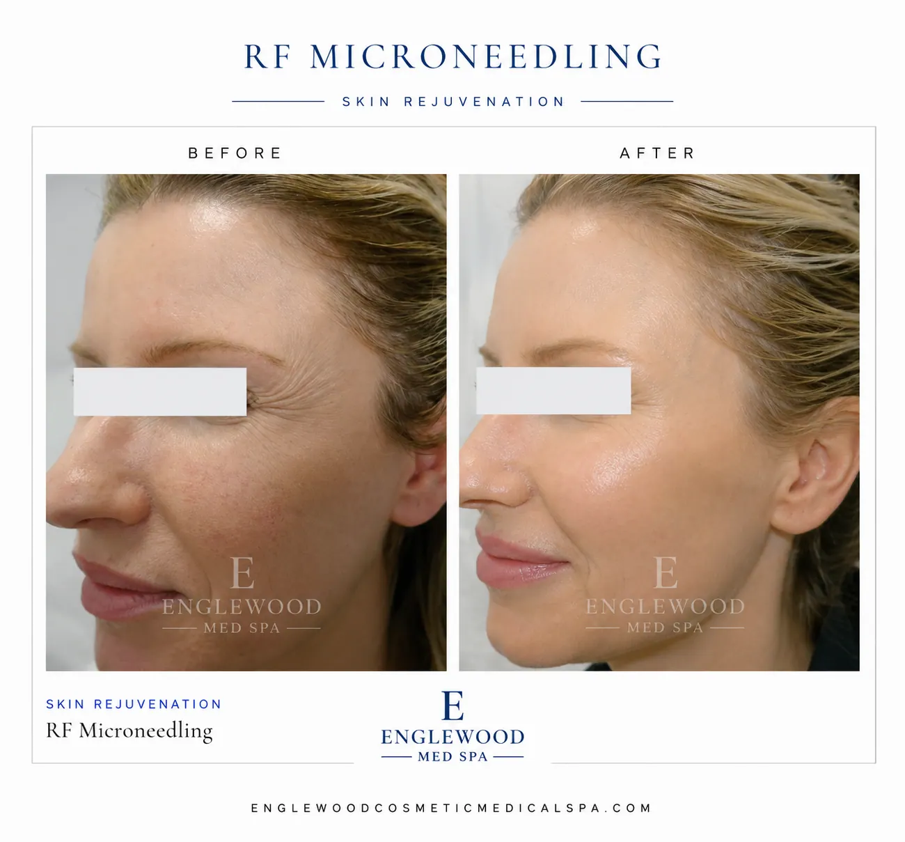 Before and after RF microneedling for smoother texture and softened lines — Englewood Cosmetic Medical Spa, Englewood NJ