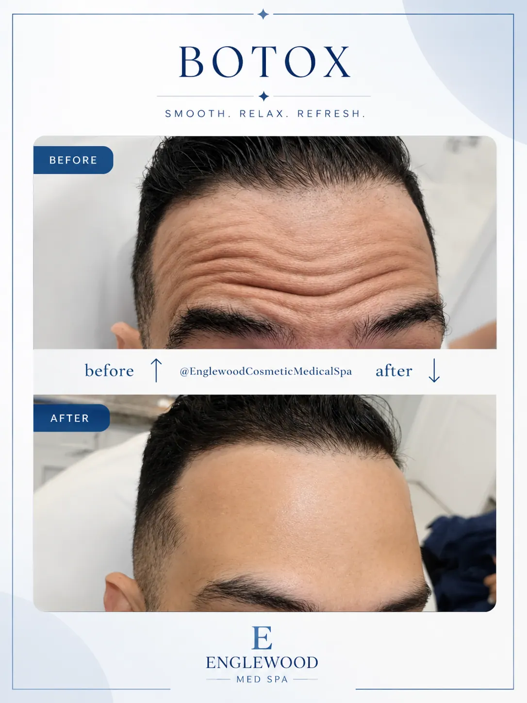 Before and after Botox for forehead lines in a male patient — Englewood Cosmetic Medical Spa, Englewood NJ