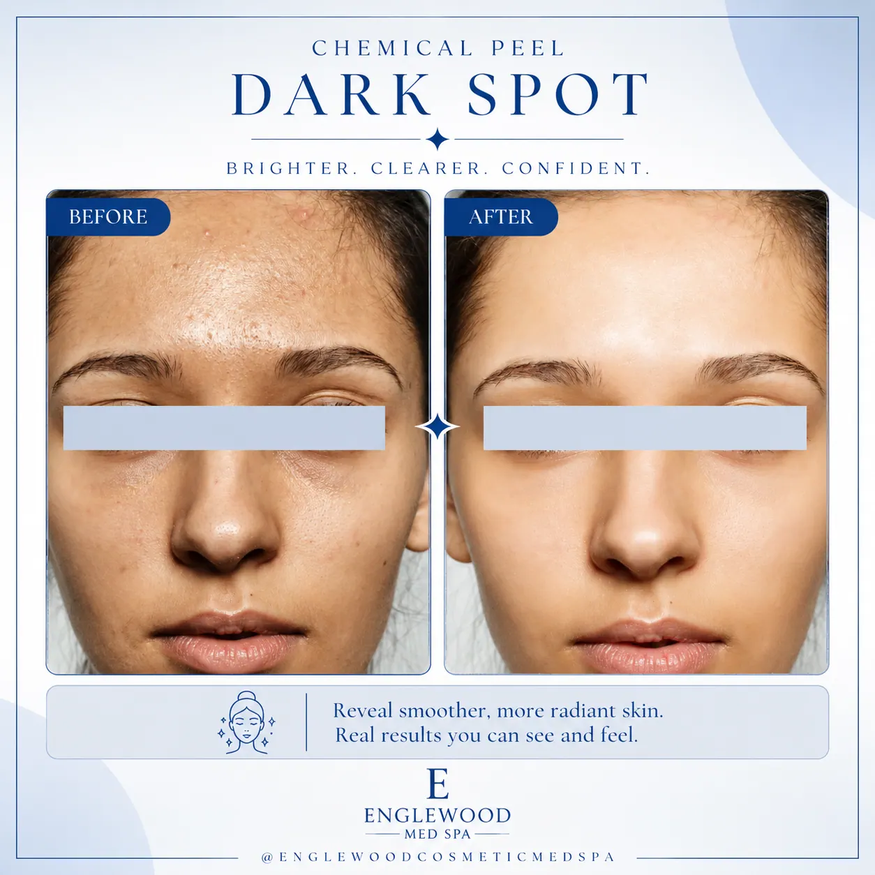 Before and after chemical peel for dark spots and uneven tone — Englewood Cosmetic Medical Spa