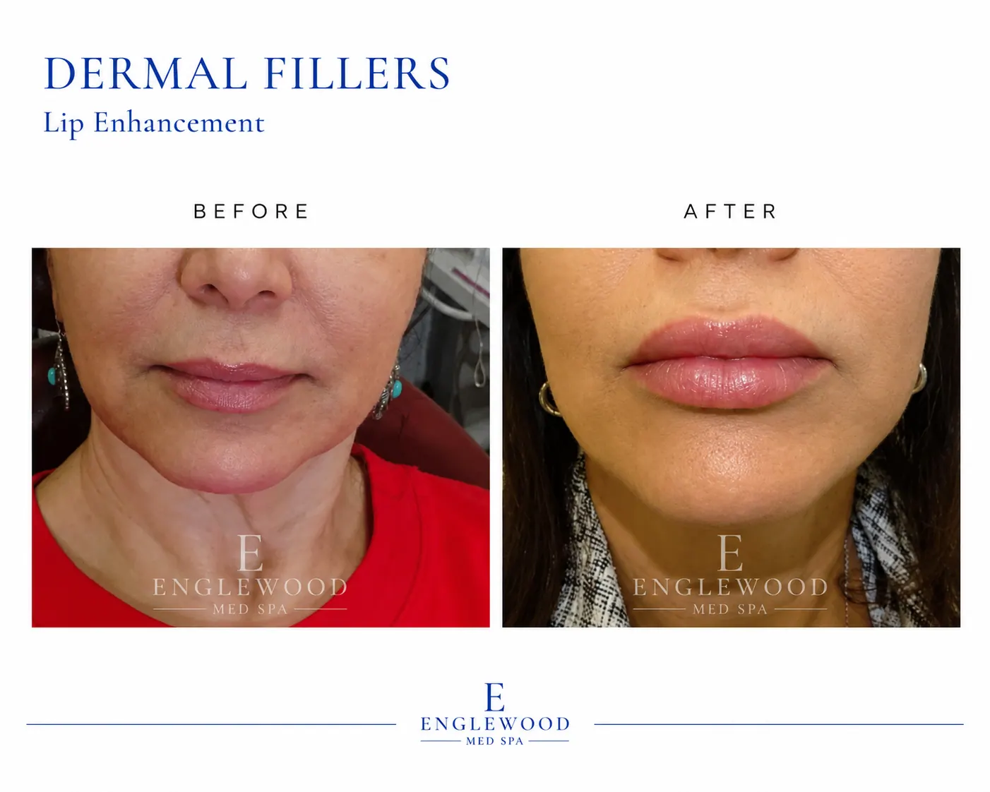 Before and after dermal filler lip enhancement — Englewood Cosmetic Medical Spa, Englewood NJ