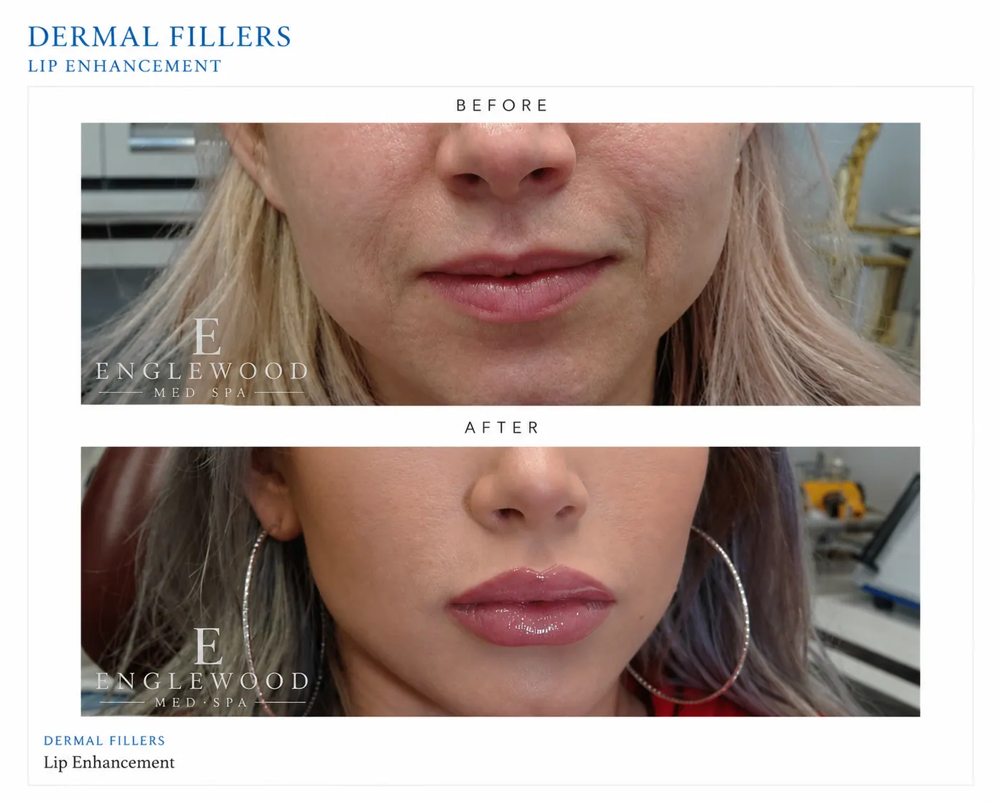 Before and after dermal filler lip enhancement — Englewood Cosmetic Medical Spa, Englewood NJ