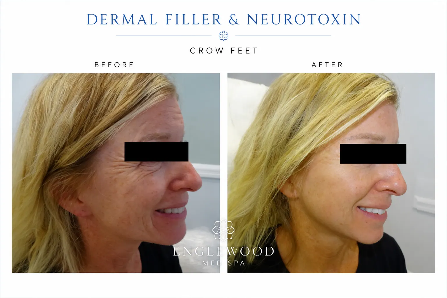 Crow's Feet before