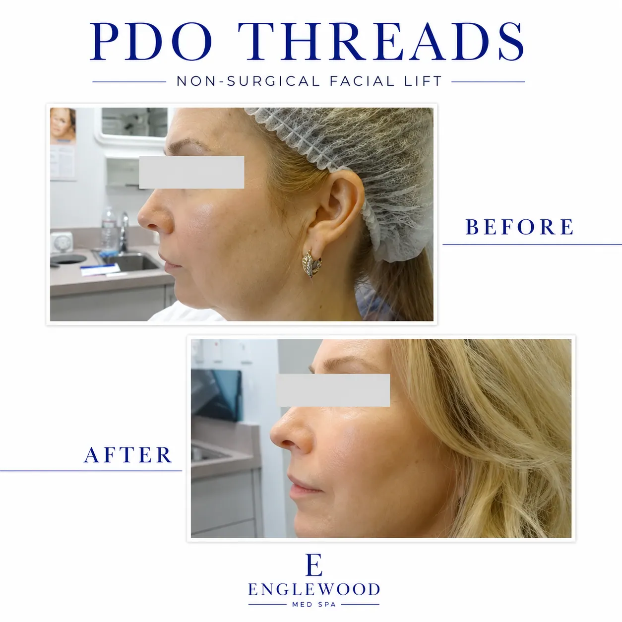 Before and after PDO thread lift, profile view with a lifted mid-face — Englewood Cosmetic Medical Spa, Englewood NJ