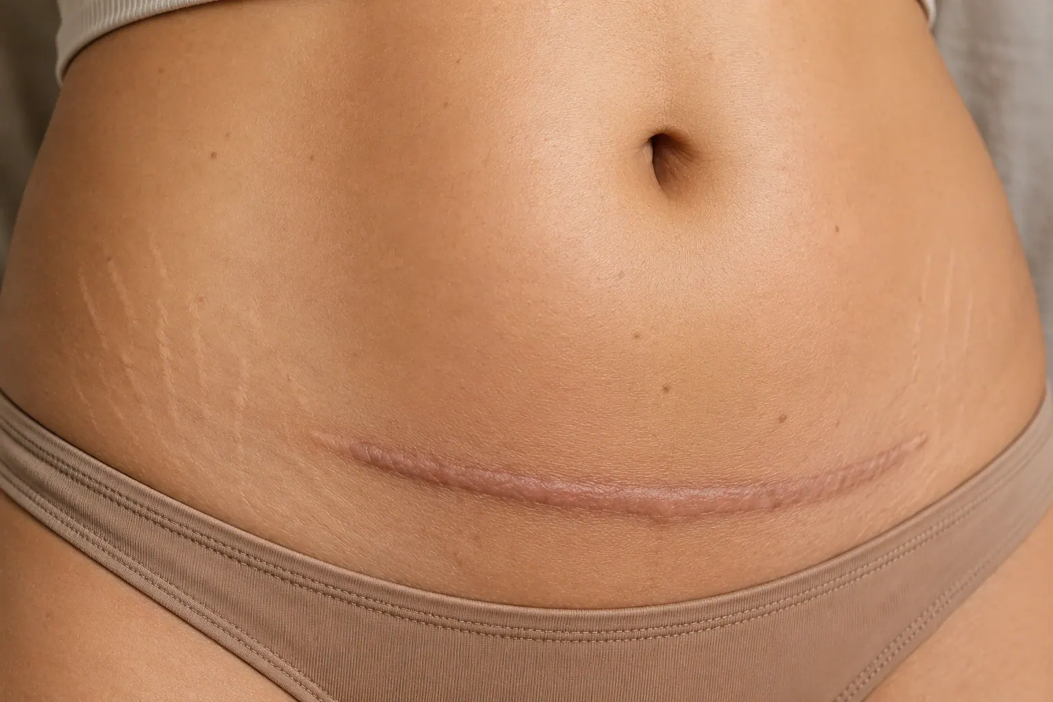 Close-up of a healed C-section scar with natural stretch marks demonstrating scar revision treatment concerns at Englewood Med Spa in Bergen County, New Jersey.