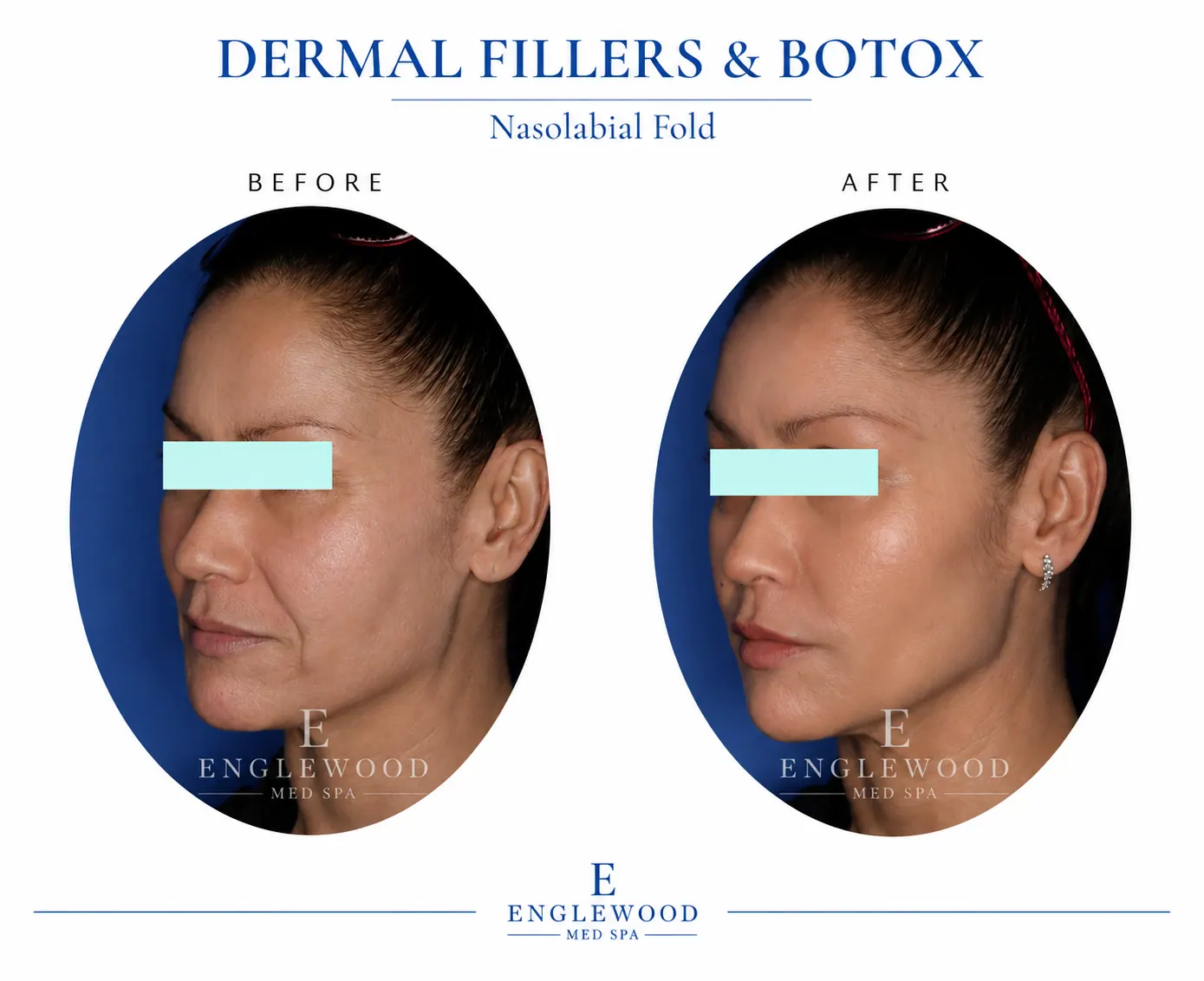 Before and after dermal filler and Botox for nasolabial folds — Englewood Cosmetic Medical Spa, Englewood NJ