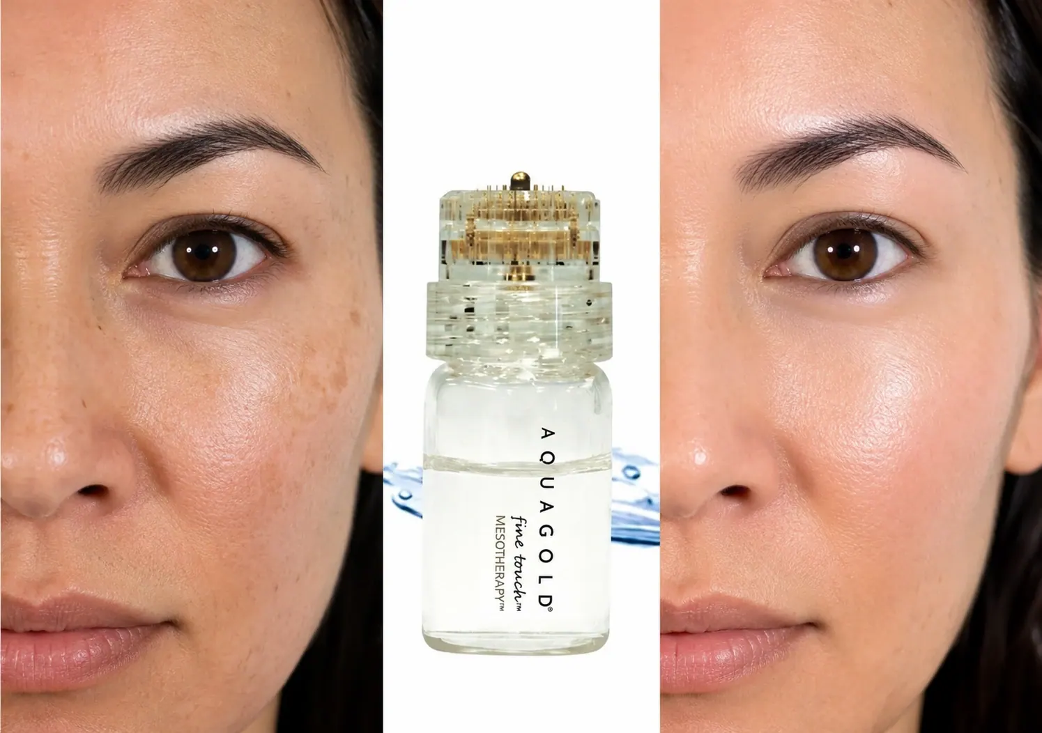 AquaGold Fine Touch Skin Rejuvenation Results Educational AquaGold Fine Touch comparison showing improvements in skin tone, texture, and radiance after treatment at Englewood Med Spa.