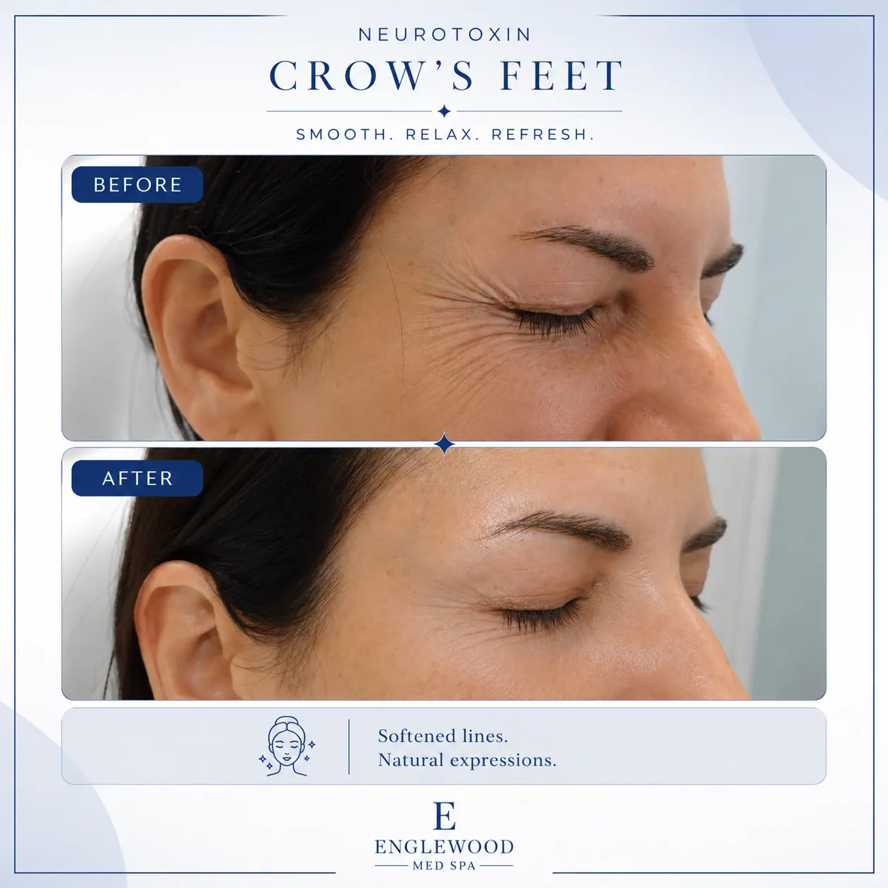 Before and after Botox for crow's feet — Englewood Cosmetic Medical Spa, Englewood NJ