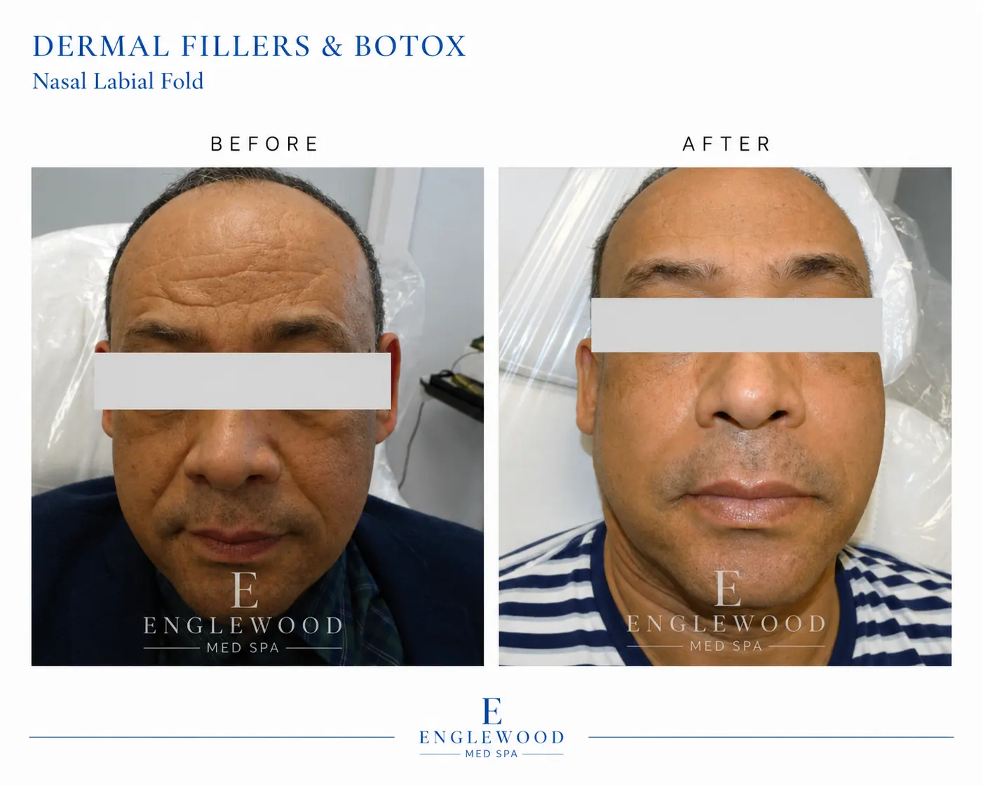 Before and after dermal filler and Botox for nasolabial folds in a male patient — Englewood Cosmetic Medical Spa, Englewood NJ