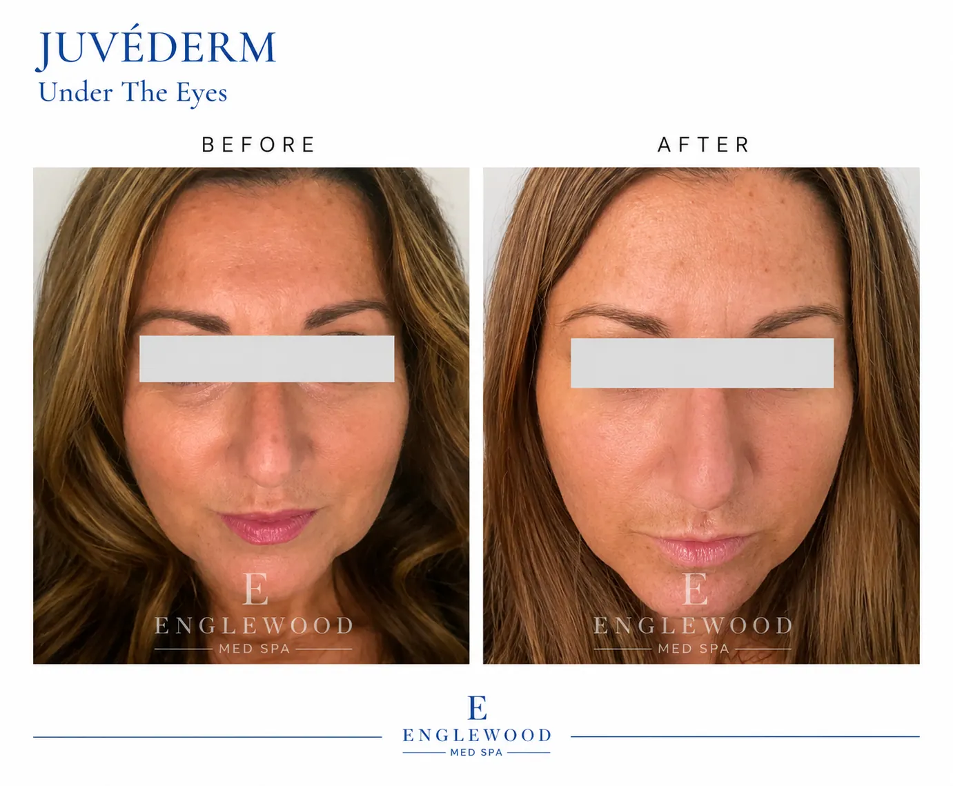 Before and after Juvéderm under-eye filler — Englewood Cosmetic Medical Spa, Englewood NJ