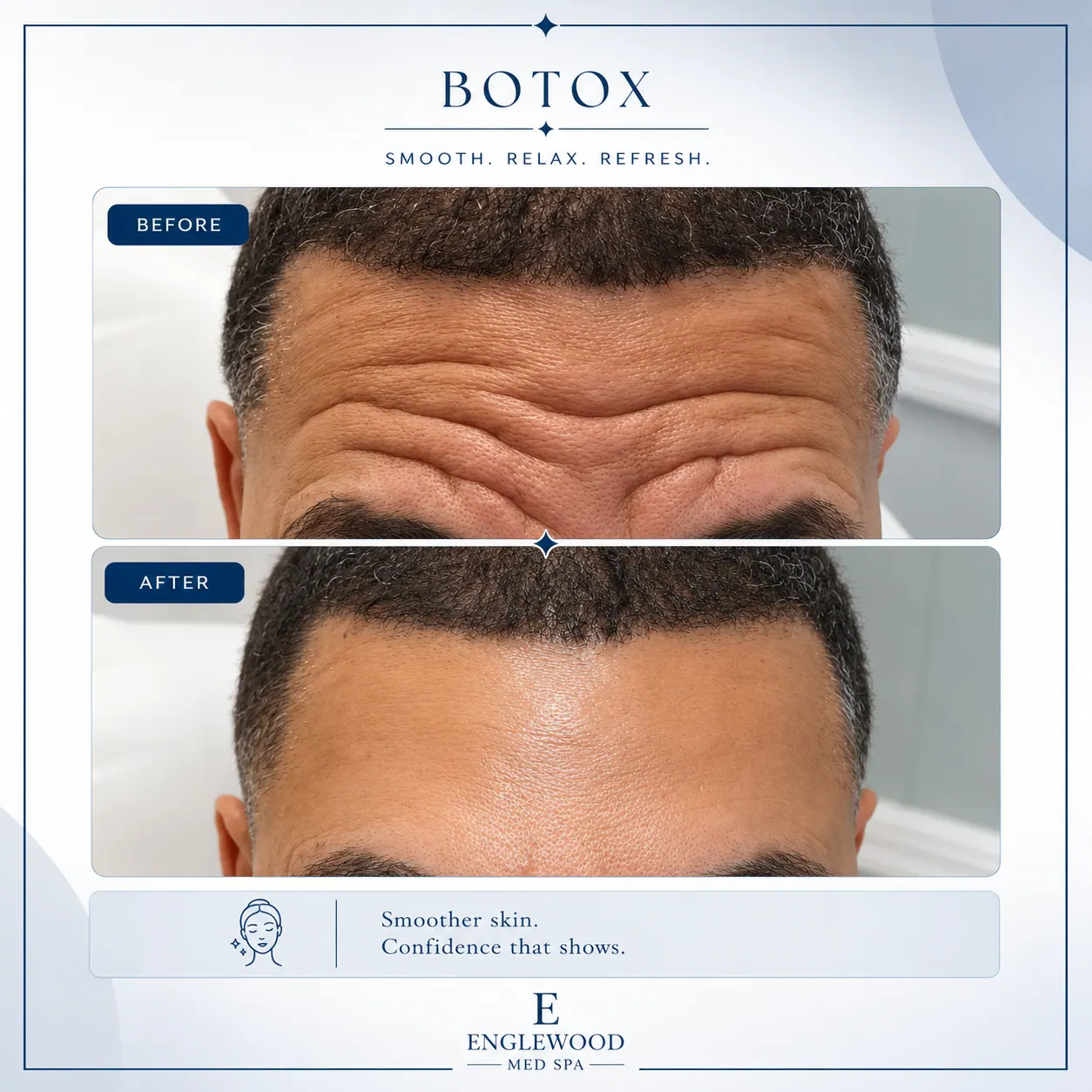 Before and after Botox for forehead lines in a male patient — Englewood Cosmetic Medical Spa, Englewood NJ