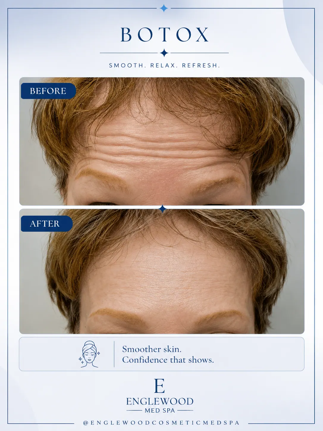 Before and after Botox for forehead lines in a male patient — Englewood Cosmetic Medical Spa, Englewood NJ