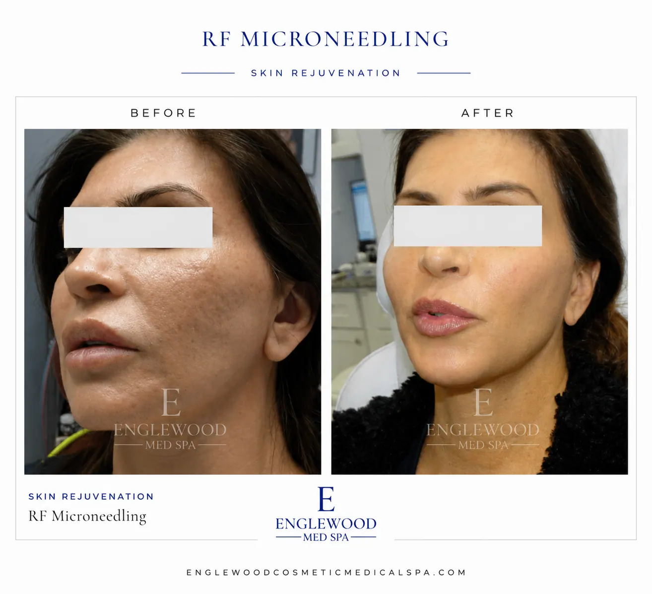 Before and after RF microneedling for pore refinement and even tone — Englewood Cosmetic Medical Spa, Englewood NJ