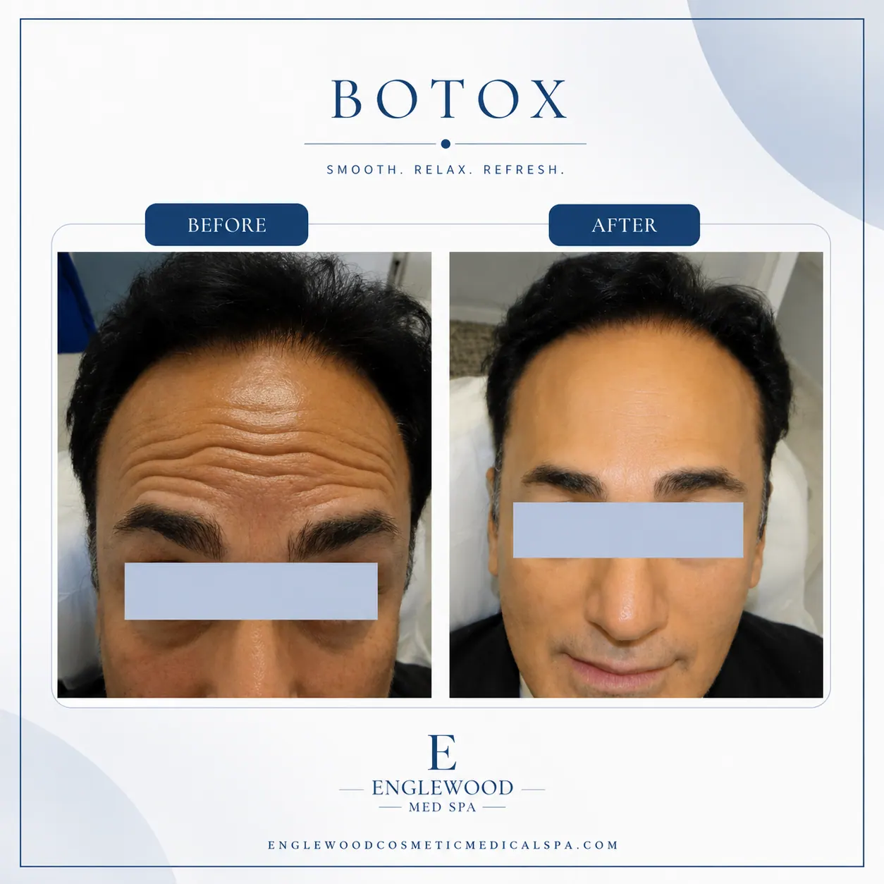 Before and after Botox for forehead lines in a male patient — Englewood Cosmetic Medical Spa, Englewood NJ