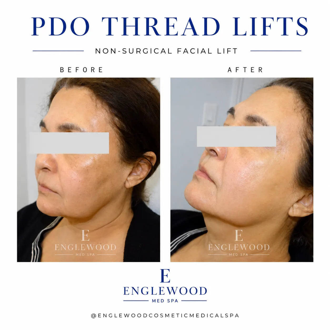 Before and after PDO thread lift for cheek and jawline lift — Englewood Cosmetic Medical Spa, Englewood NJ