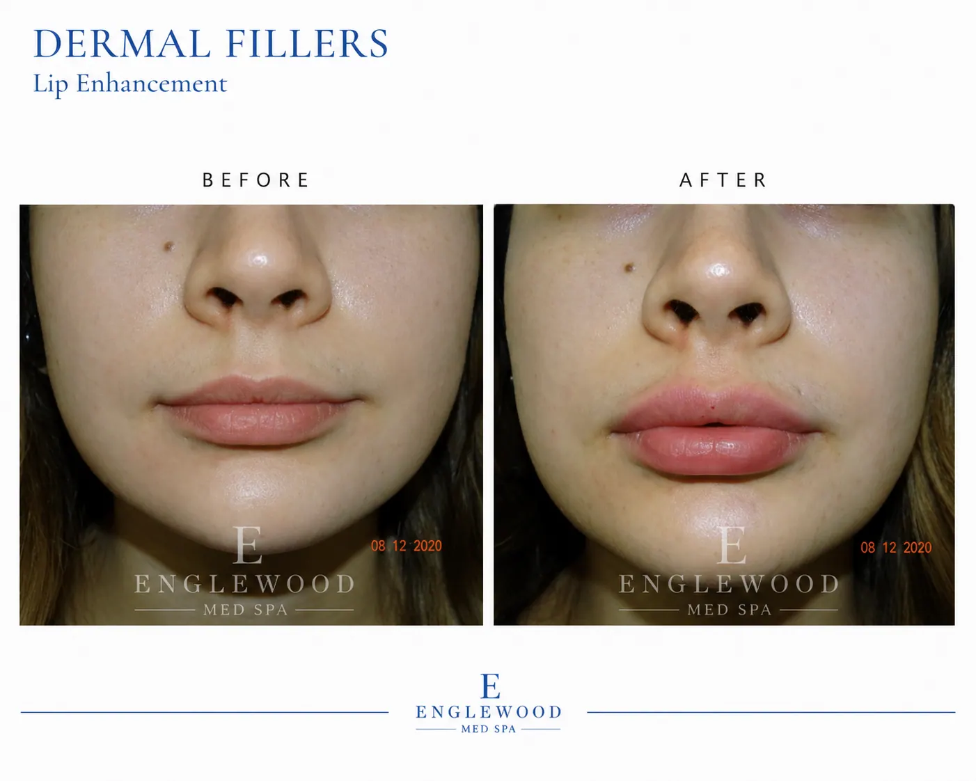 Before and after dermal filler lip enhancement — Englewood Cosmetic Medical Spa, Englewood NJ