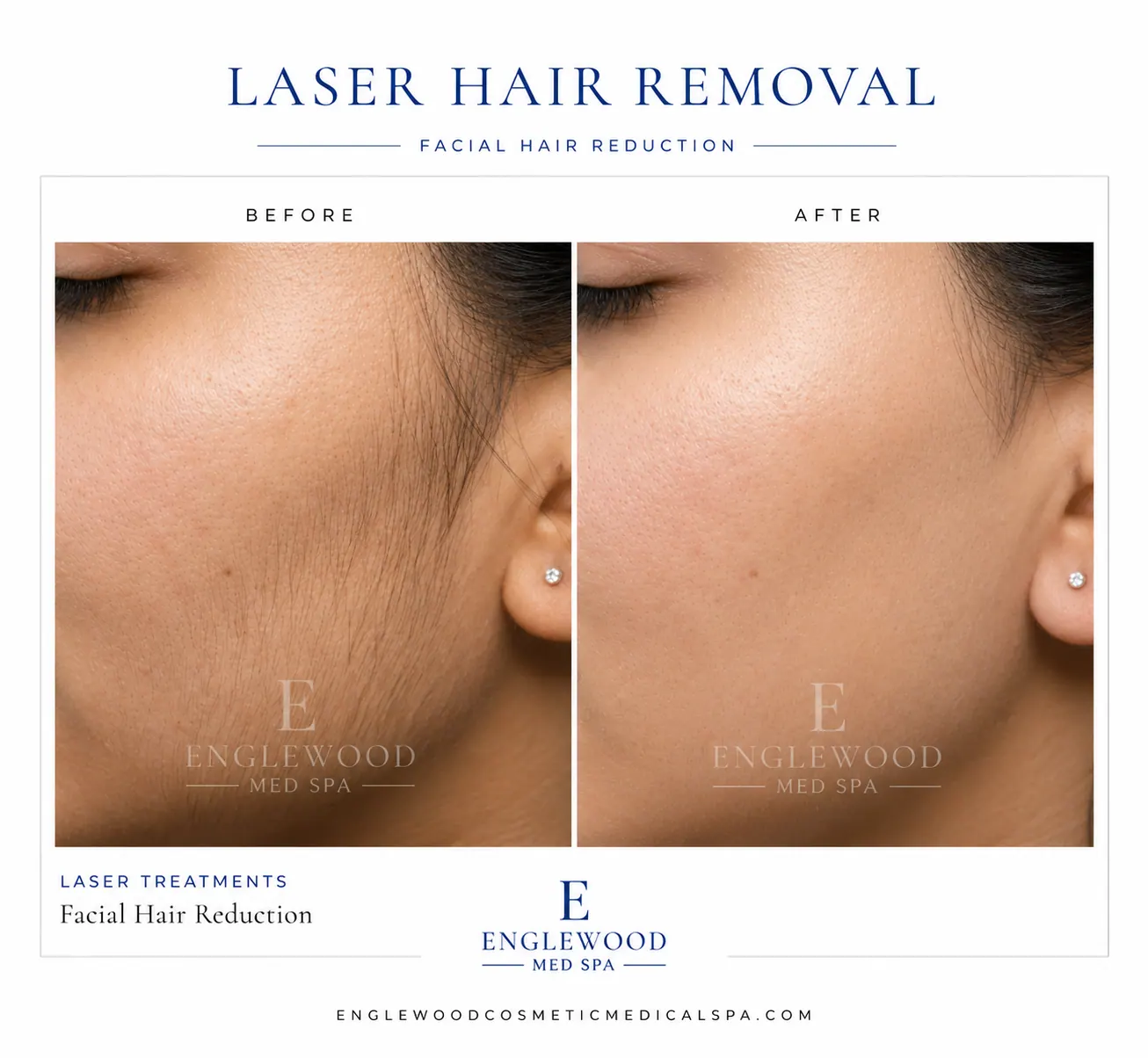 Before and after laser hair removal for facial hair reduction — Englewood Cosmetic Medical Spa, Englewood NJ