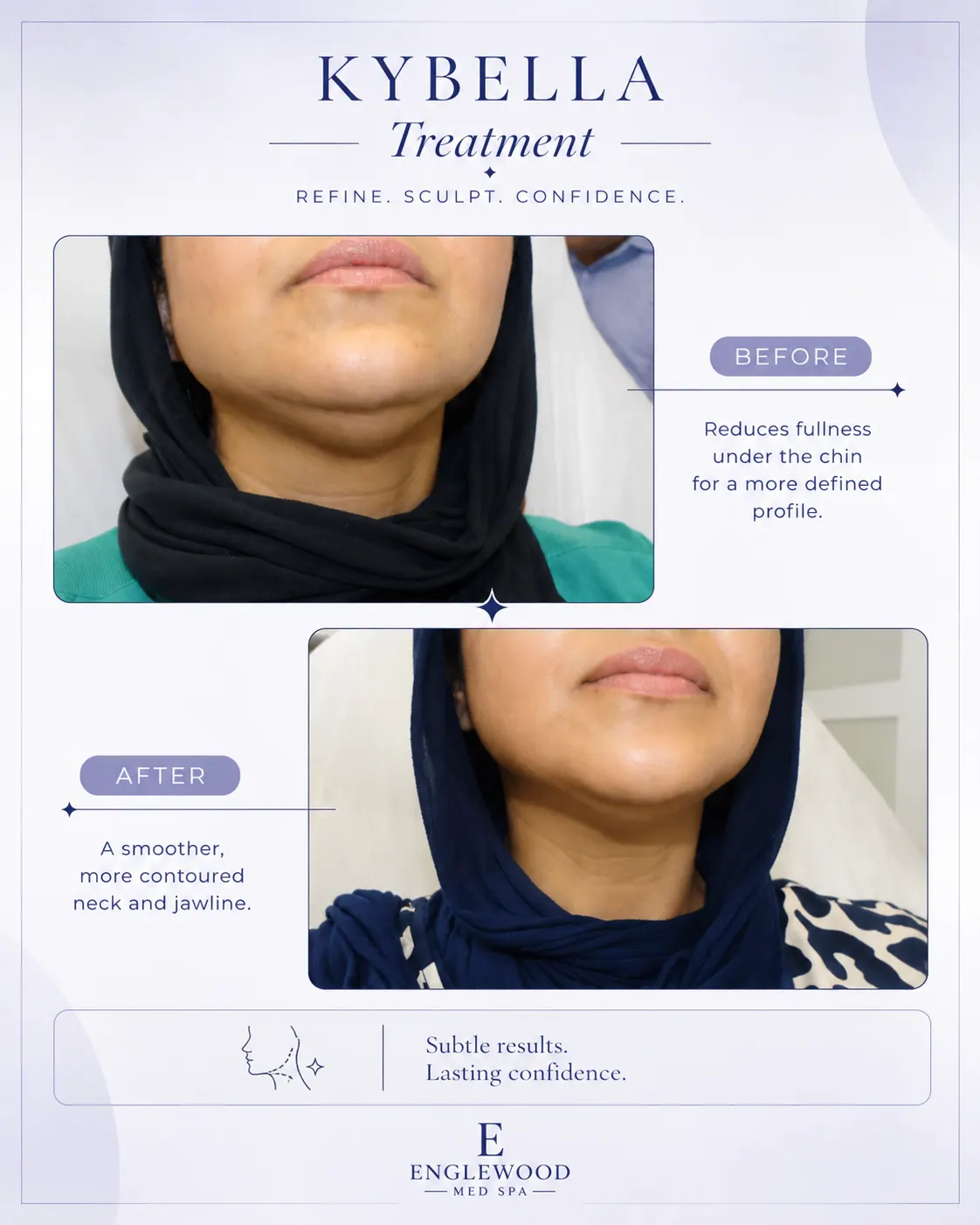 Before and after Kybella treatment for a smoother, more contoured jawline — Englewood Cosmetic Medical Spa