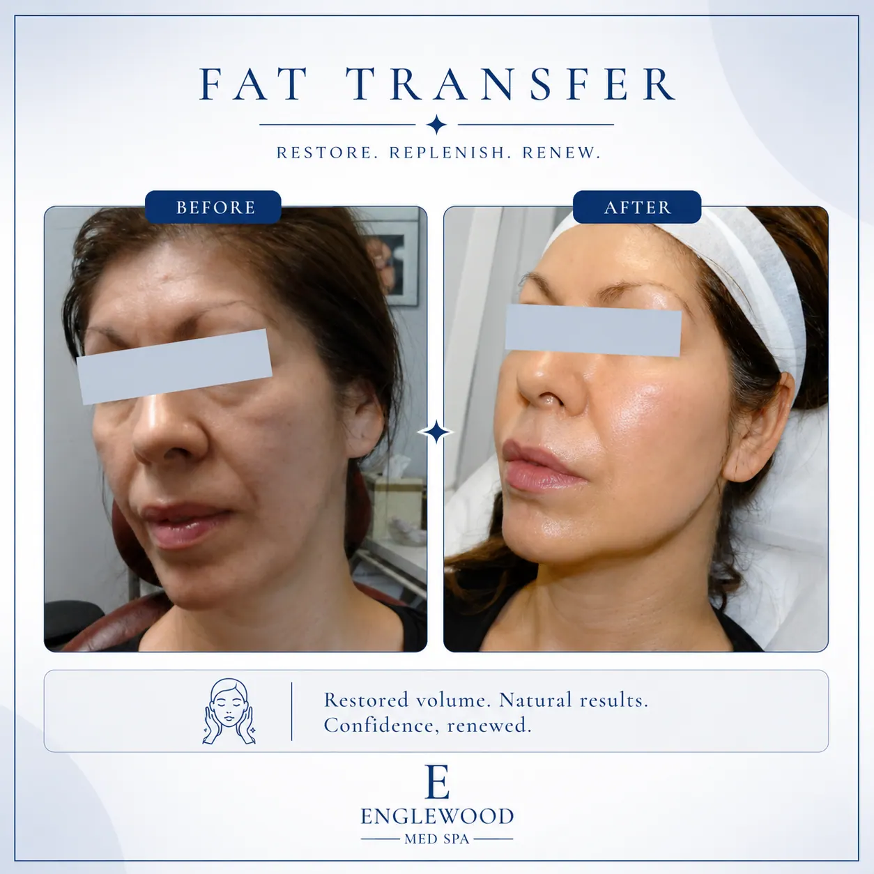 Before and after facial fat transfer for restored volume — Englewood Cosmetic Medical Spa