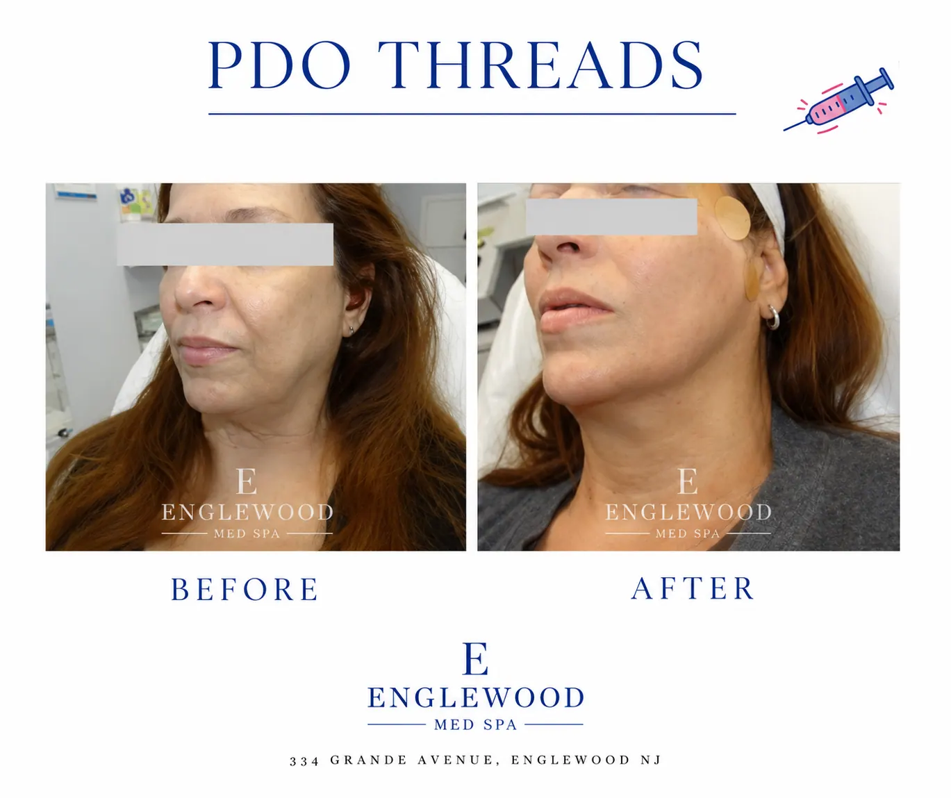Before and after PDO thread lift for jawline and jowl definition — Englewood Cosmetic Medical Spa, Englewood NJ