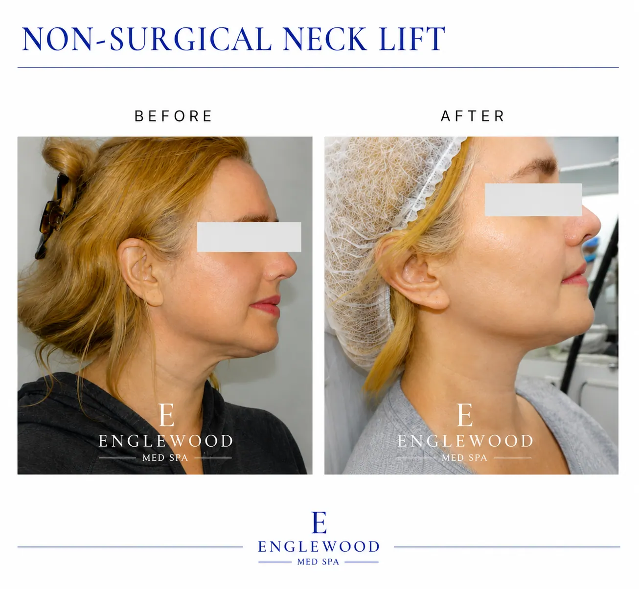Before and after non-surgical neck lift for loose skin and skin tightening — Englewood Cosmetic Medical Spa, Englewood NJ