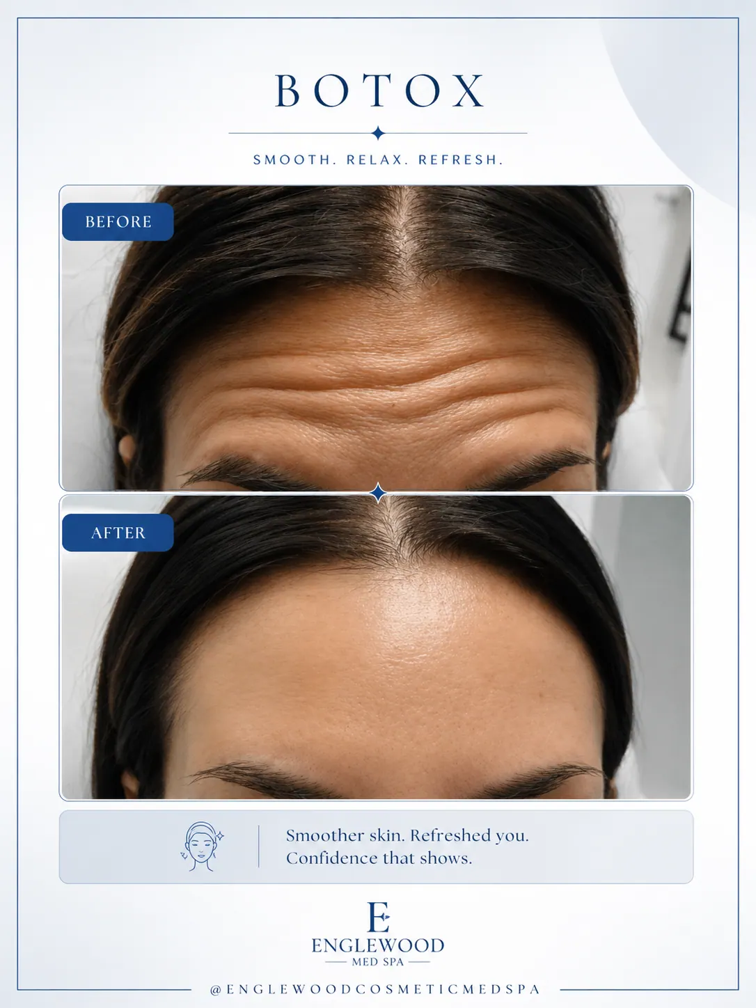 Before and after Botox for forehead lines — Englewood Cosmetic Medical Spa, Englewood NJ