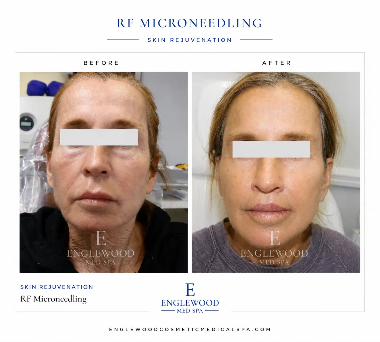 Before and after RF microneedling for firmer, smoother facial skin — Englewood Cosmetic Medical Spa, Englewood NJ