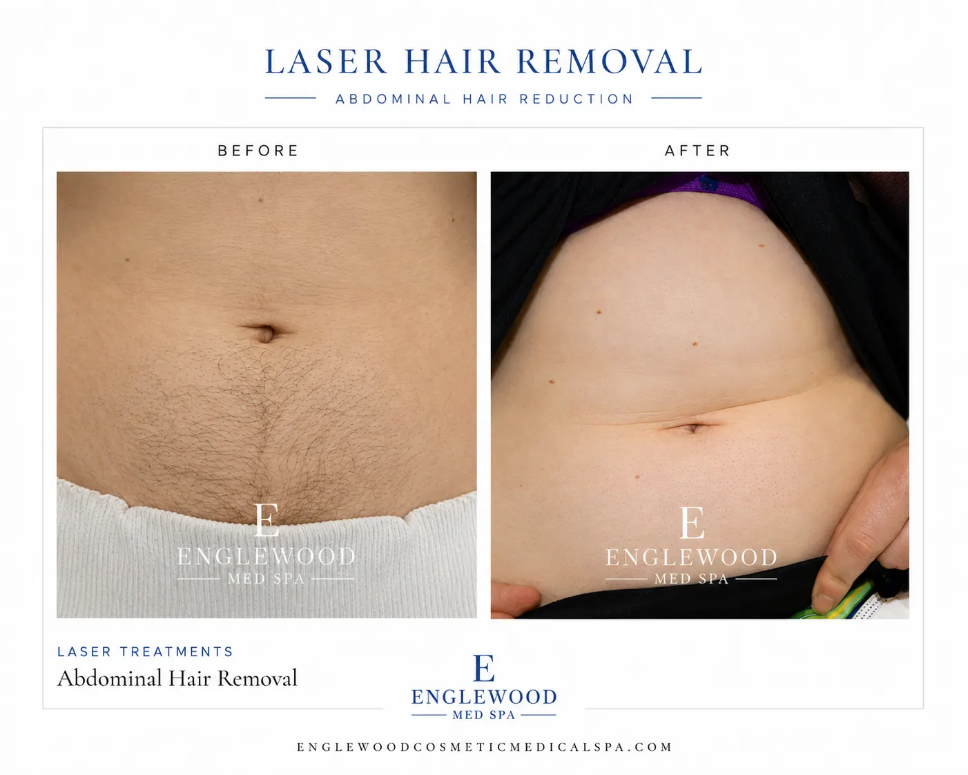 Before and after laser hair removal for abdominal hair reduction — Englewood Cosmetic Medical Spa, Englewood NJ