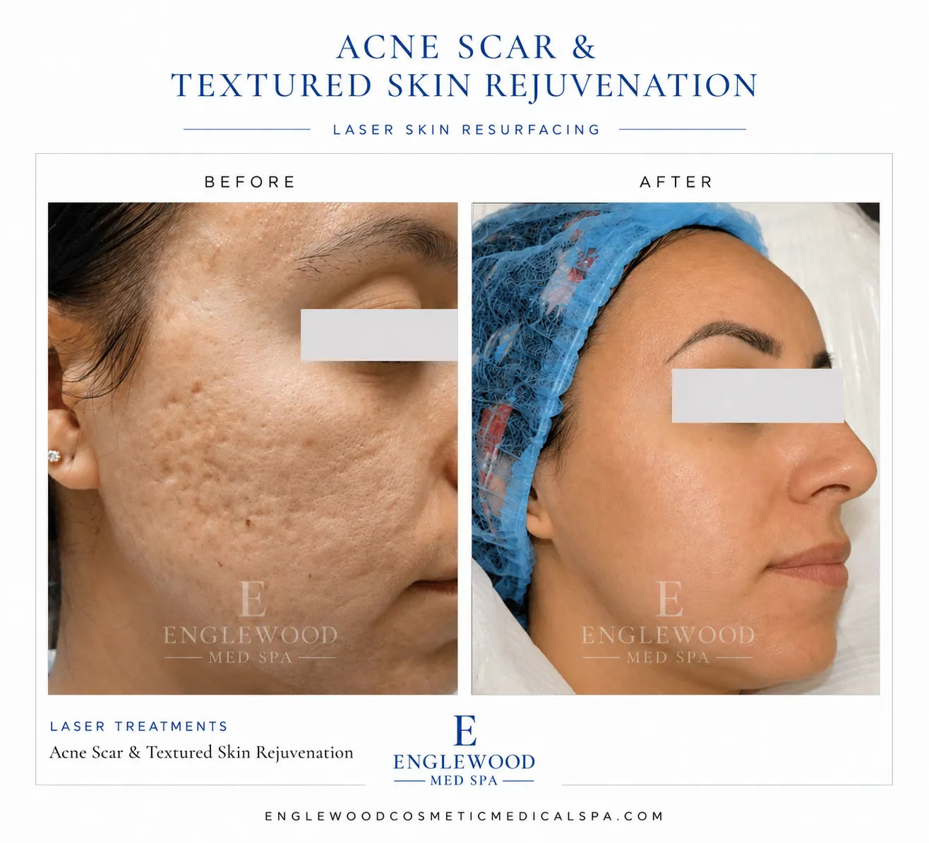 Before and after laser skin resurfacing for acne scars and uneven texture — Englewood Cosmetic Medical Spa, Englewood NJ